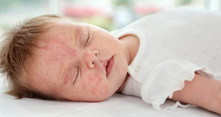 شیر خشک گیگوز برای حساسیت به پروتئین گاوی